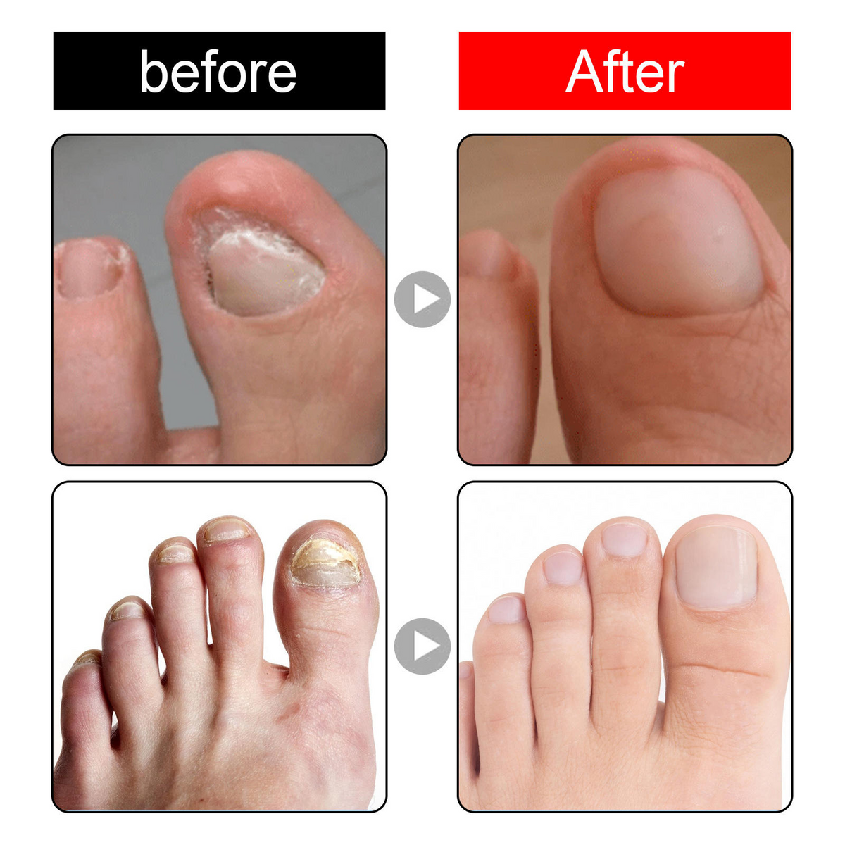 Southmoon Ingrown Toenail Drops Nail Repair Oil (BUY 1 GET 1 FREE🔥🔥)
