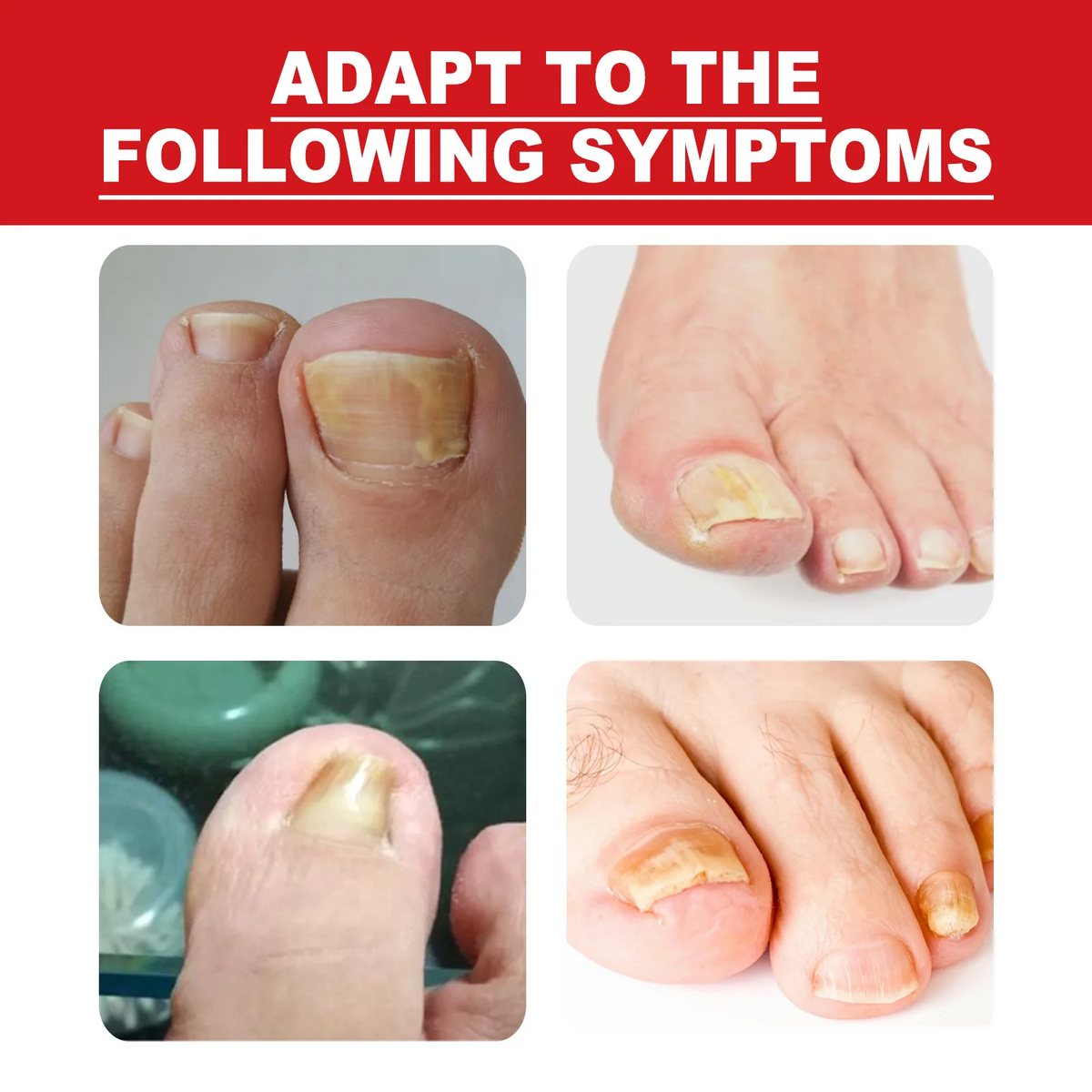 Southmoon Ingrown Toenail Drops Nail Repair Oil (BUY 1 GET 1 FREE🔥🔥)