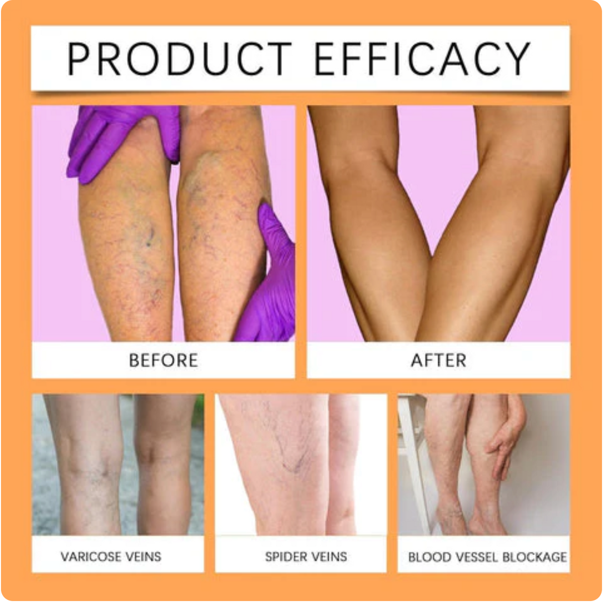 Varicose Veins Relief Herbal Spray - (Buy 1 Get 1 FREE🔥🔥)