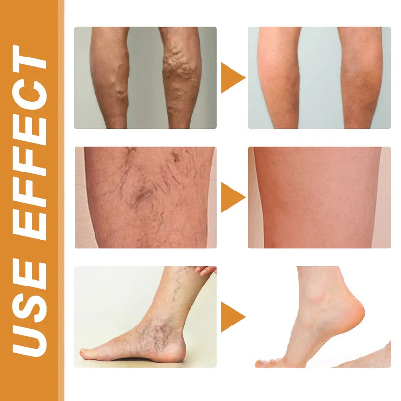 Vein Healing Varicose Veins Treatment Spray (Buy 1 Get 1 Free)