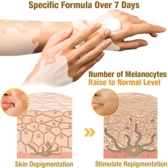 VitiGO™ Bee Venom Corrector Cream - (Buy 1 Get 1 Free🔥🔥)