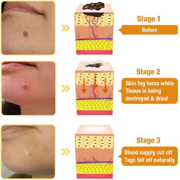 Original Bee Venom Wart & Skin Tag Remover Spray -(Buy 1 Get 1 FREE🔥🔥)